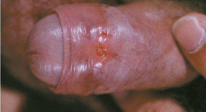 Lymphogranuloma venereum:
