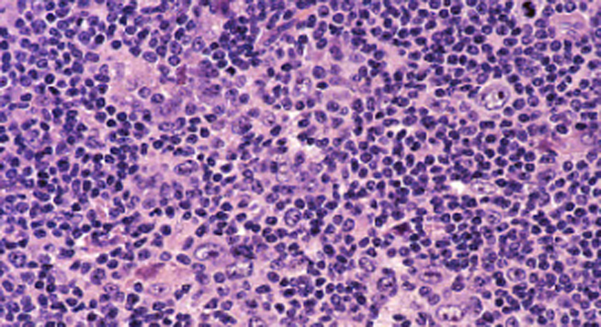 Lymphome: weisse Blutkörperchen, Lymphozyten im Blutbild