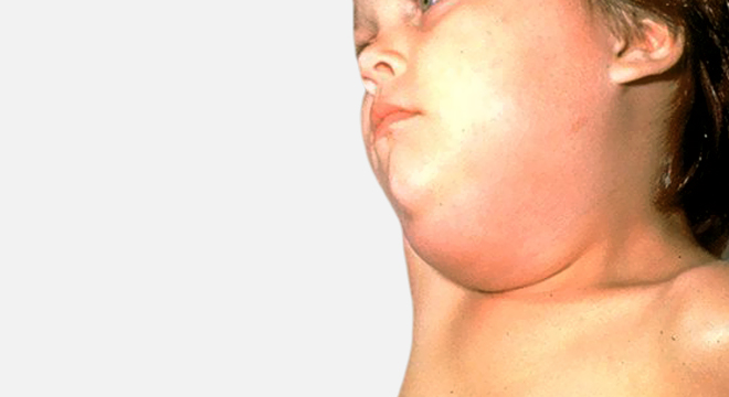 Mumps: infektiöse hochansteckende Krankheit