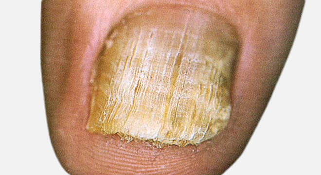 Nagelpilz: ansteckende Pilzinfektion