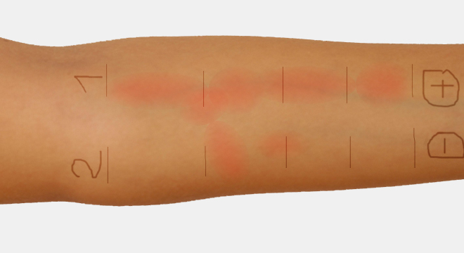 Nesselsucht: Allergennachweis mittels Hauttests und Bluttests