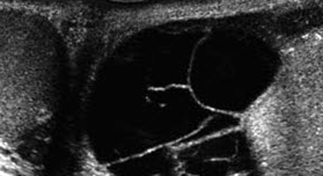 Nebenhodenetzündung: Ultraschall der Hoden
