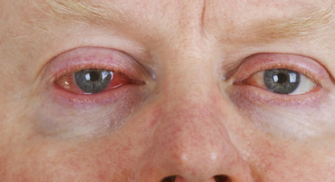 Rotes Auge deutet meist auf eine Infektion oder auf einen Fremdkörper im Auge hin