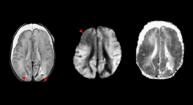 Schütteltrauma beim Kind: Computertomographie des Schädels