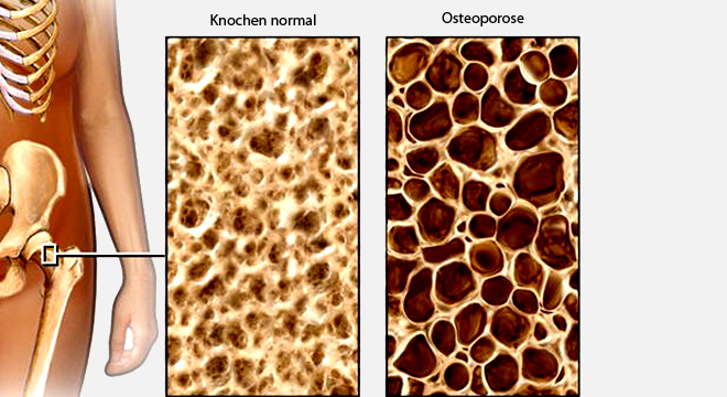 Schenkelhalsbruch: zum Beispiel durch Osteoporose