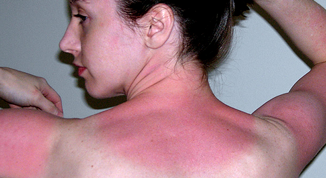 Sonnenbrand: Rötung, Schmerzen, Jucken, Blasenbildung durch zuviel Sonne
