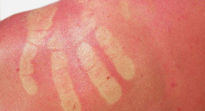 Sonnenbrand: Verbrennung der Haut durch UV-Strahlung