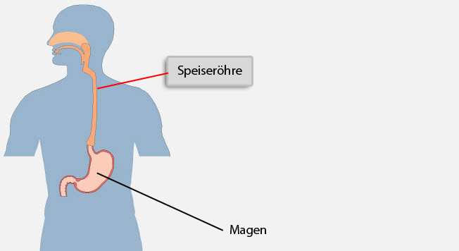 Speiseröhrenkrebs: Bösartige Zellveränderungen in der Schleimhaut der Speiseröhre