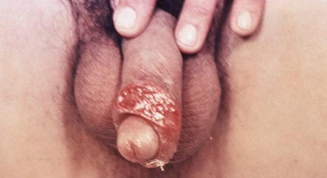 Syphilis: gefähliche, ansteckende bakterielle Geschlechtskrankheit