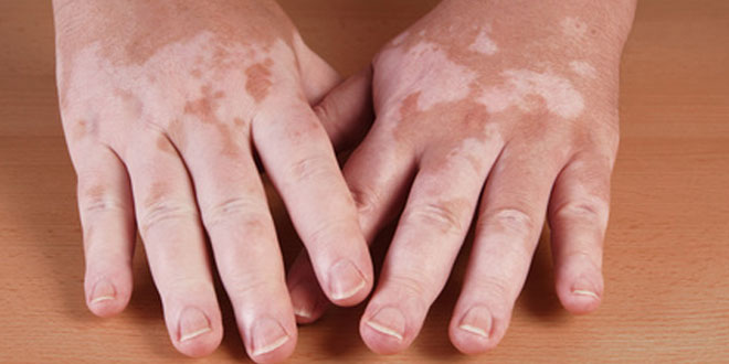 Vitiligo auch Weissfleckenkrankheit gilt als chronische Hautkrankheit
